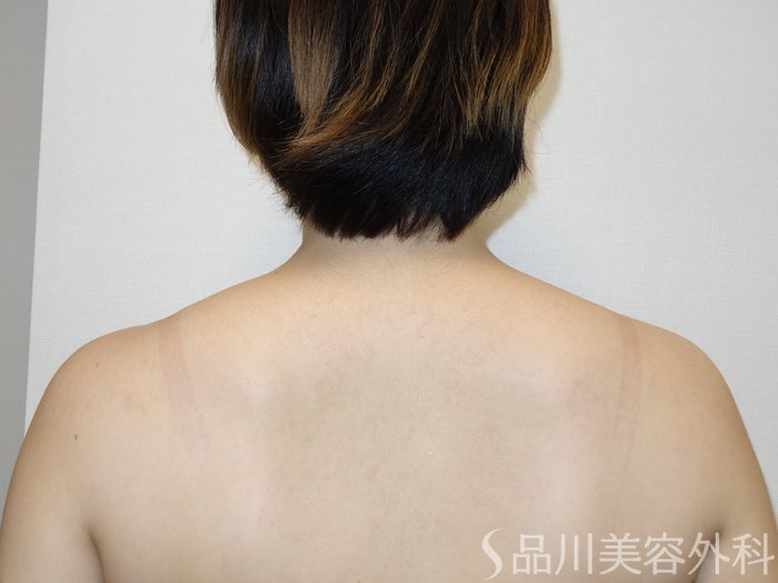 症例NO.65343のBEFORE写真