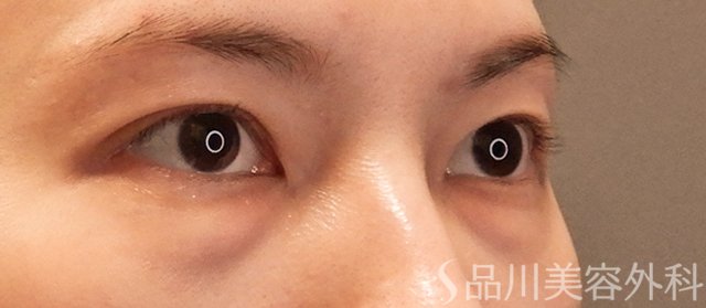 症例NO.72268のBEFORE写真