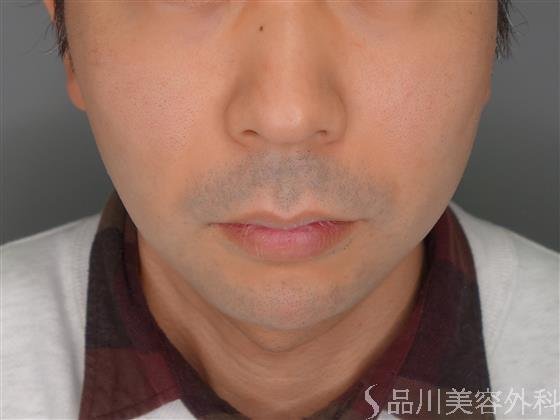 症例NO.53677のAFTER写真
