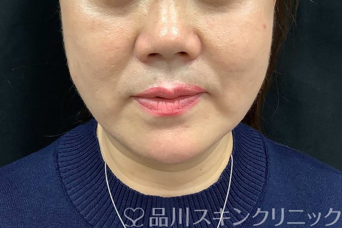 症例NO.71283のAFTER写真