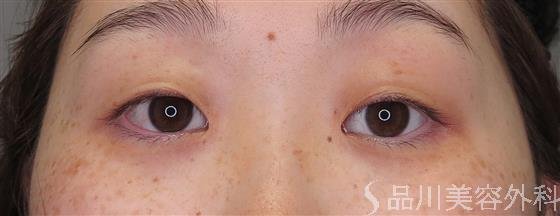 症例NO.47993のBEFORE写真