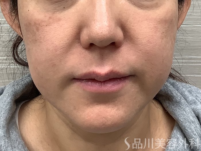 症例NO.62263のBEFORE写真