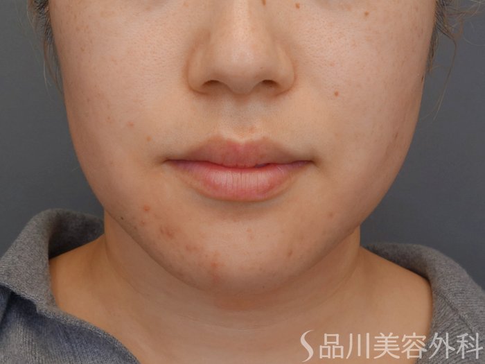 症例NO.72709のBEFORE写真