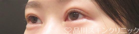 症例NO.59158のAFTER写真