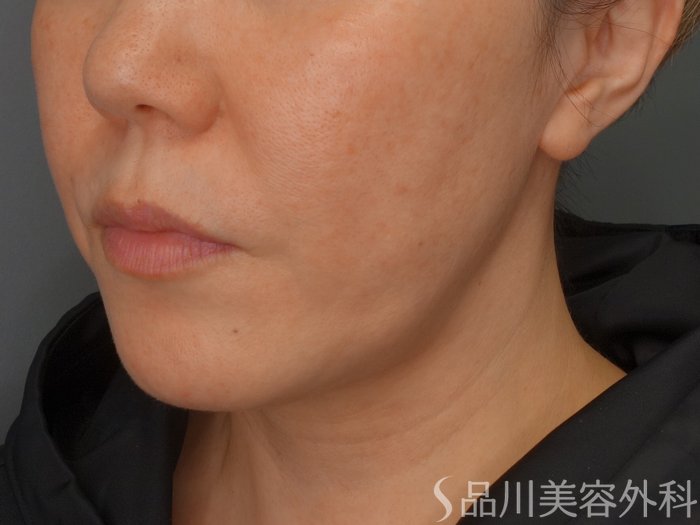 症例NO.67510のBEFORE写真