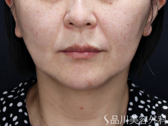 症例NO.71633のBEFORE写真