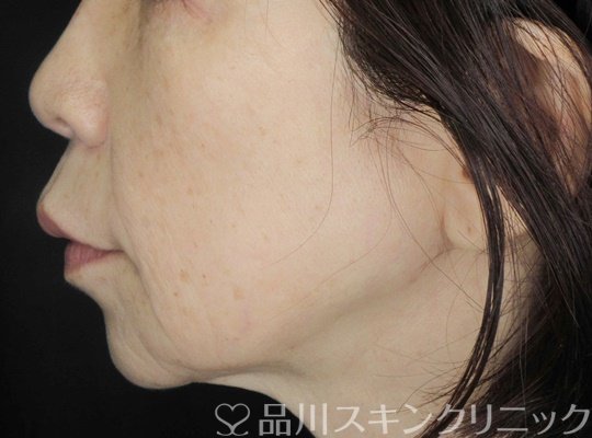 症例NO.67680のBEFORE写真