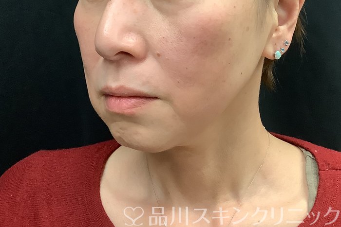 症例NO.71293のBEFORE写真