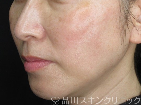 症例NO.70364のBEFORE写真