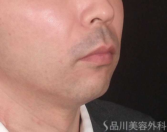 症例NO.69192のBEFORE写真