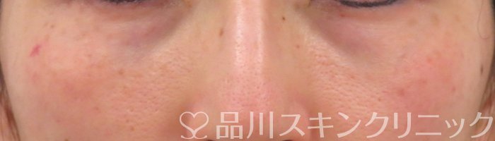 症例NO.66423のBEFORE写真