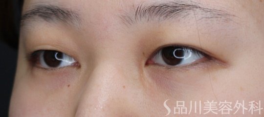 症例NO.72181のBEFORE写真