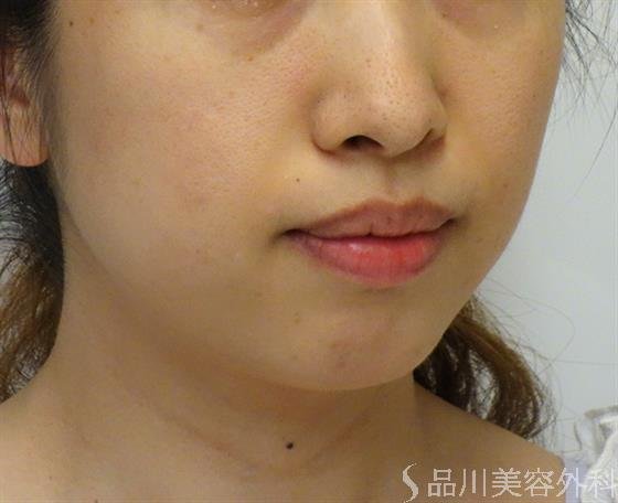 症例NO.39685のBEFORE写真