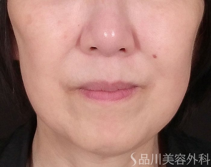 症例NO.70239のBEFORE写真