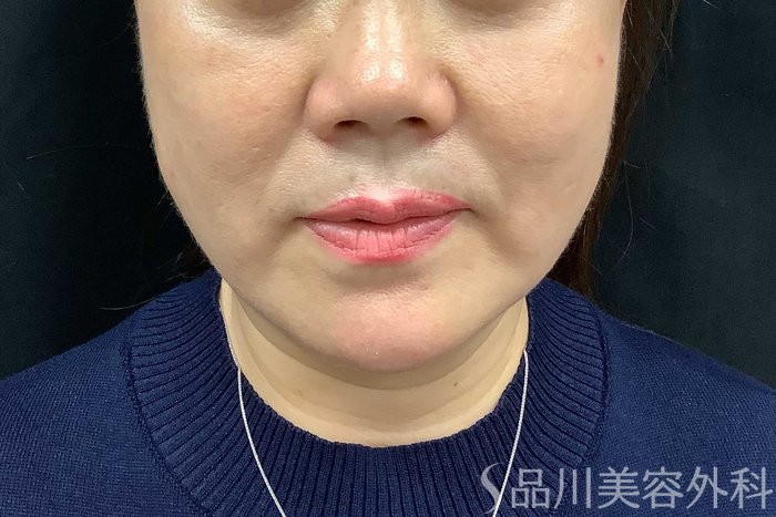 症例NO.71283のAFTER写真