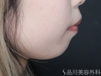 症例NO.69934のBEFORE写真