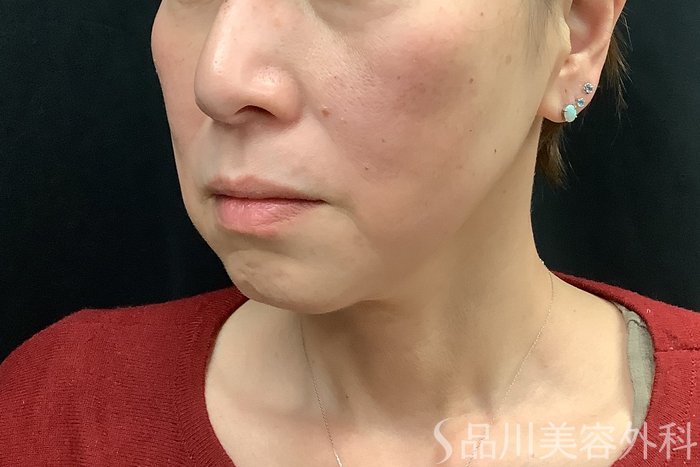 症例NO.71293のBEFORE写真