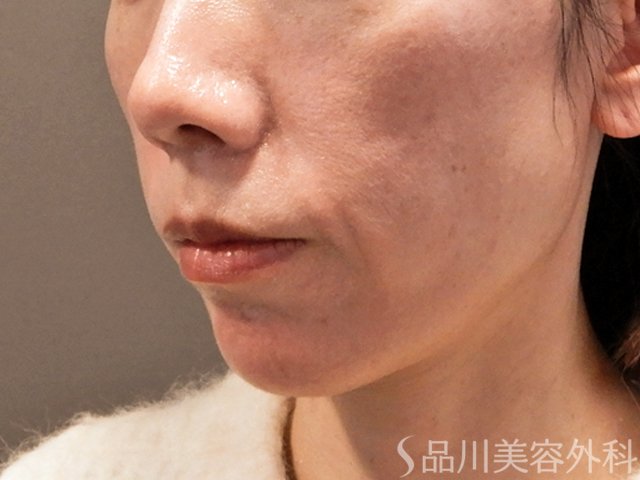 症例NO.69825のBEFORE写真
