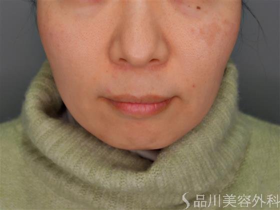 症例NO.55049のBEFORE写真