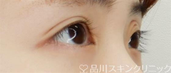 症例NO.54996のAFTER写真