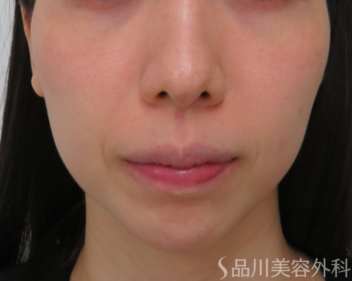症例NO.64952のBEFORE写真