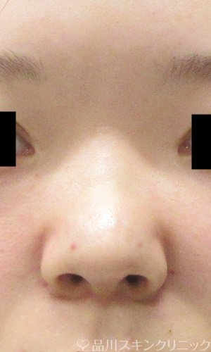 症例NO.65649のAFTER写真