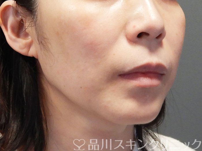 症例NO.74687のBEFORE写真