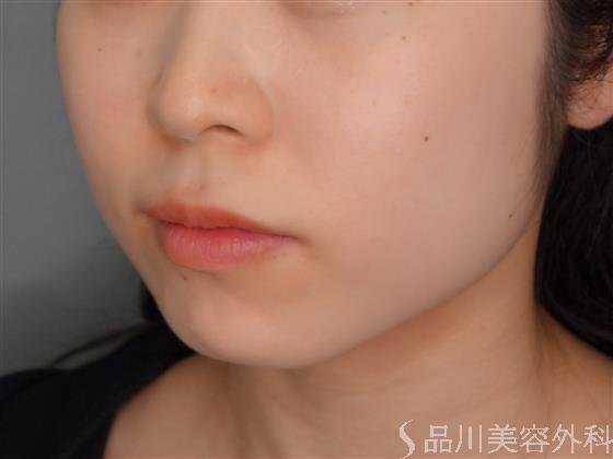 症例NO.54188のBEFORE写真