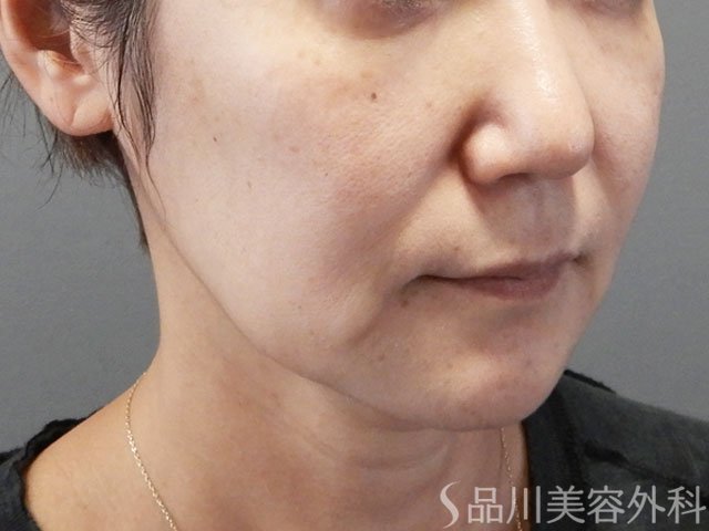 症例NO.71955のBEFORE写真