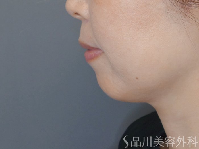 症例NO.71028のBEFORE写真