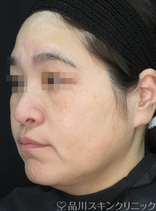 症例NO.72138のAFTER写真