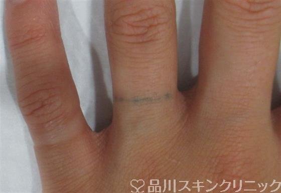 症例NO.25642のBEFORE写真