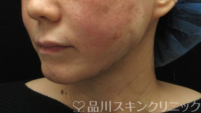 症例NO.71320のAFTER写真