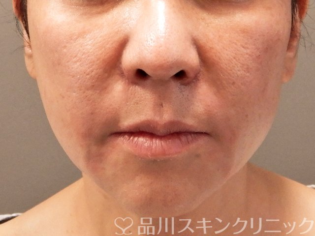 症例NO.69756のAFTER写真