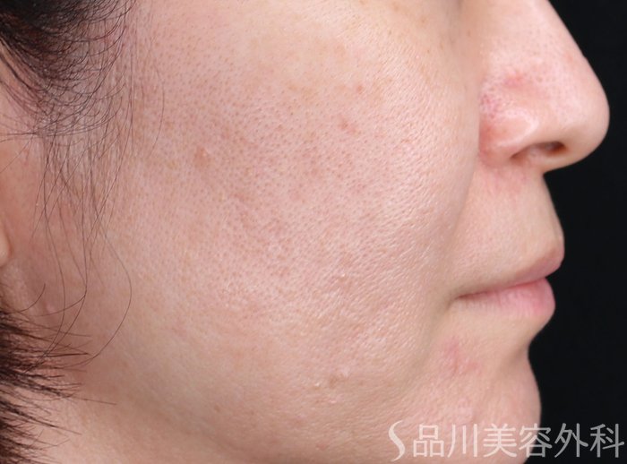 症例NO.73877のBEFORE写真