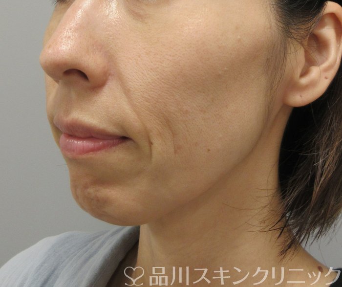 症例NO.74366のBEFORE写真