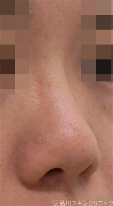 症例NO.37720のBEFORE写真