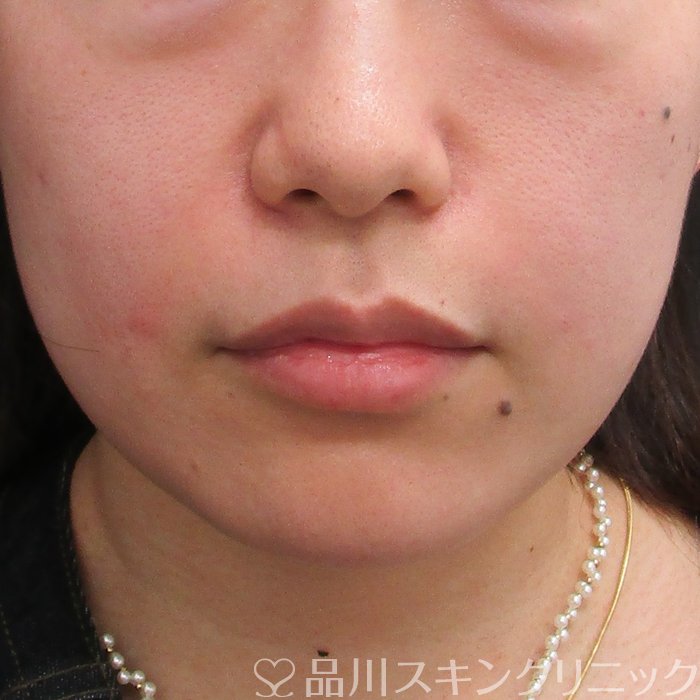 症例NO.74056のAFTER写真