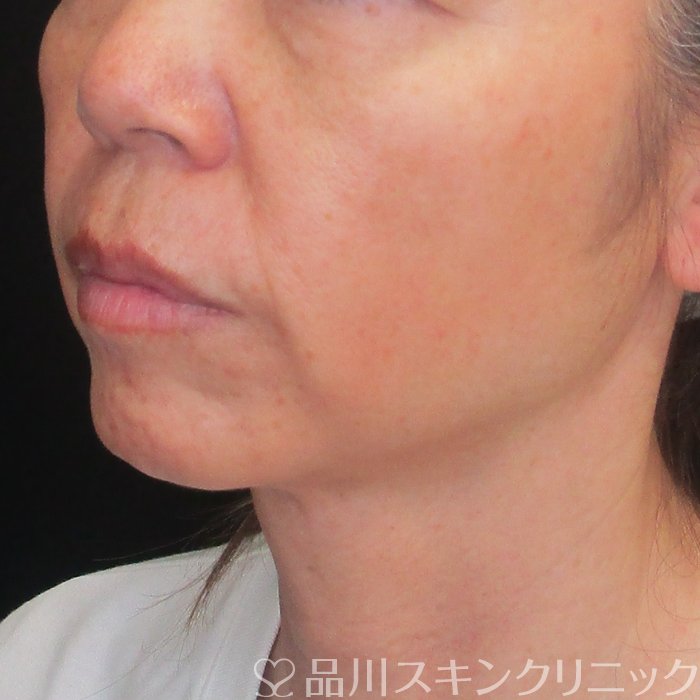 症例NO.73962のBEFORE写真