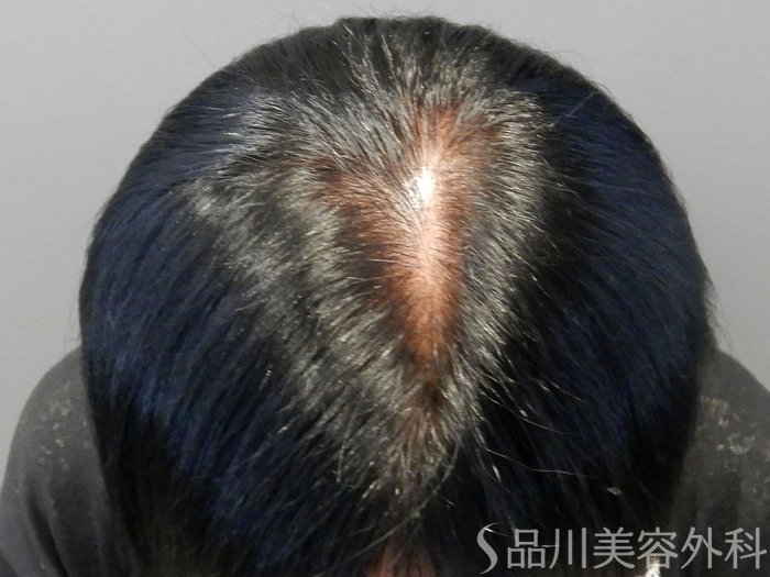 症例NO.69781のBEFORE写真