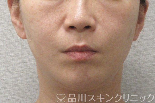 症例NO.74556のAFTER写真