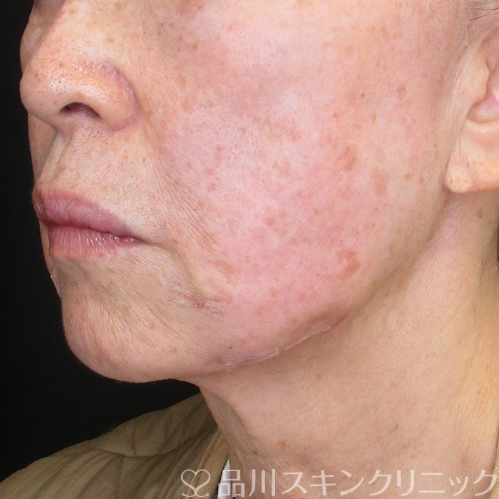 症例NO.72843のAFTER写真