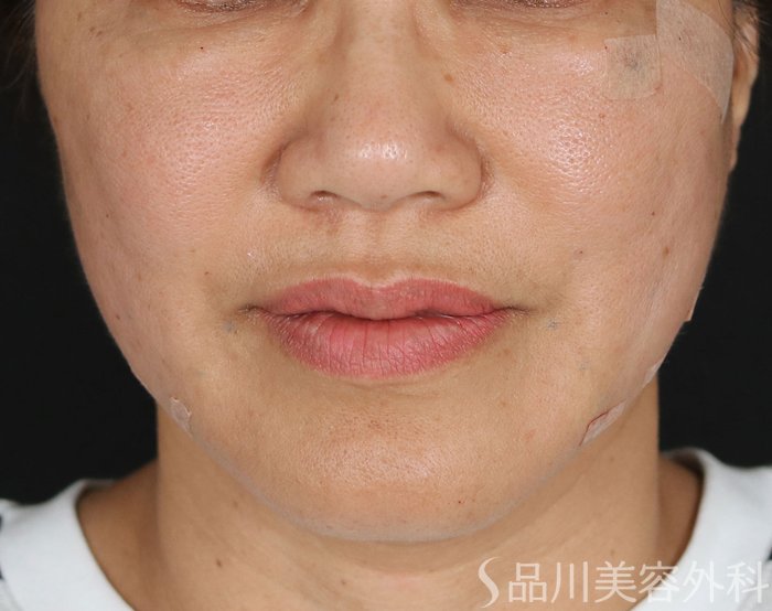 症例NO.73598のAFTER写真