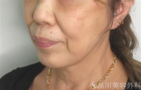 症例NO.51952のBEFORE写真