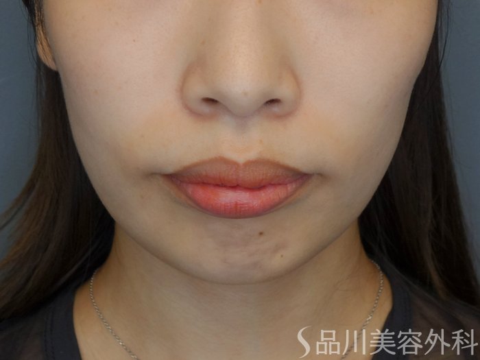 症例NO.70492のBEFORE写真