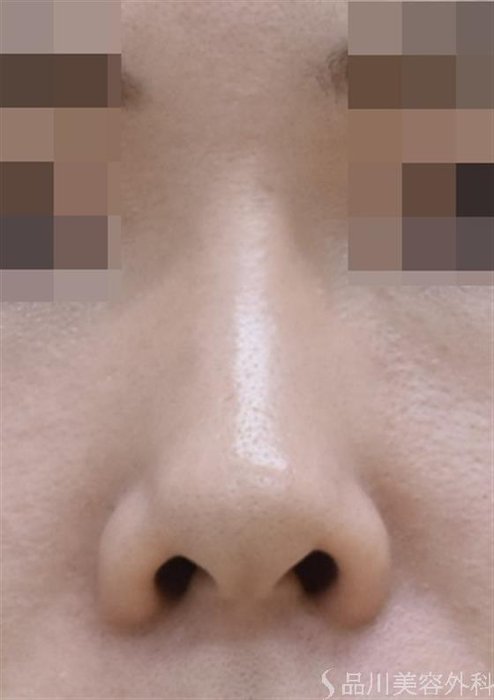 症例NO.44113のBEFORE写真