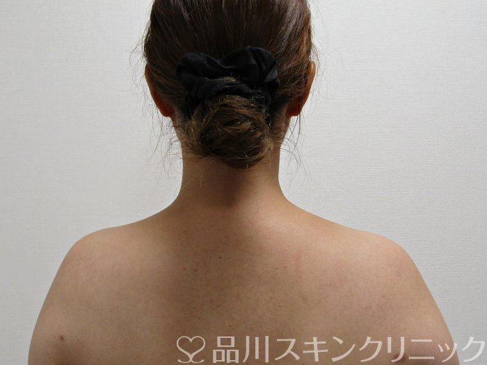 症例NO.75094のBEFORE写真