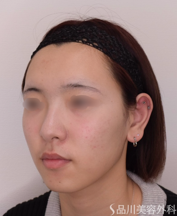 症例NO.68423のAFTER写真