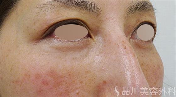症例NO.50882のAFTER写真