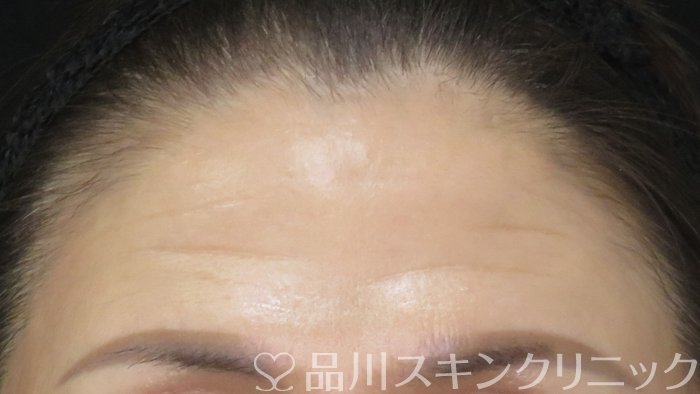 症例NO.70773のBEFORE写真